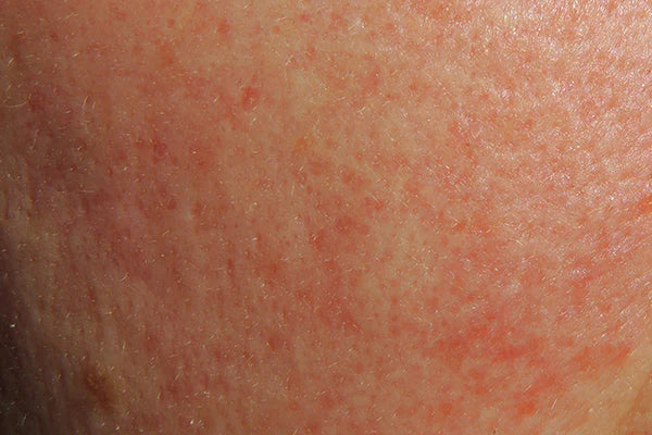 Irritations de la peau